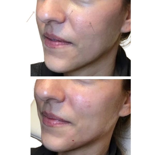 Facial Balancing with Fillers Before and After 1