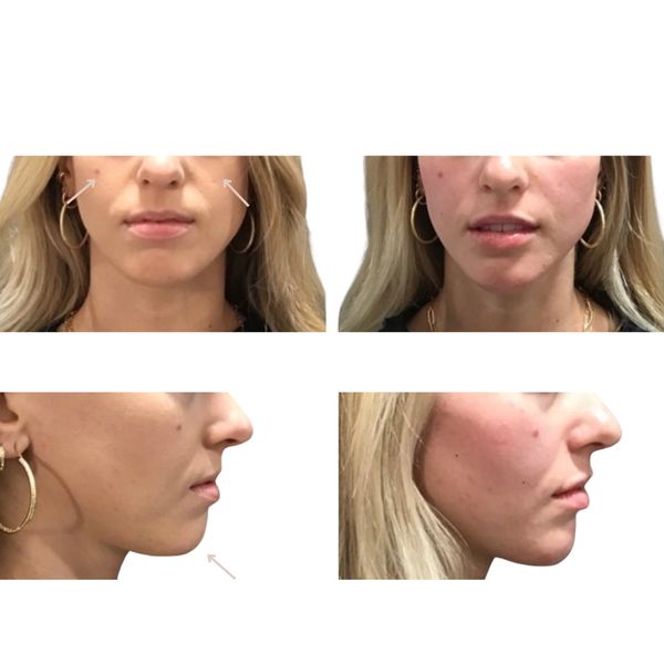 Facial Balancing with Fillers Before and After 3