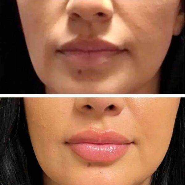 Lip Filler Before and After 2