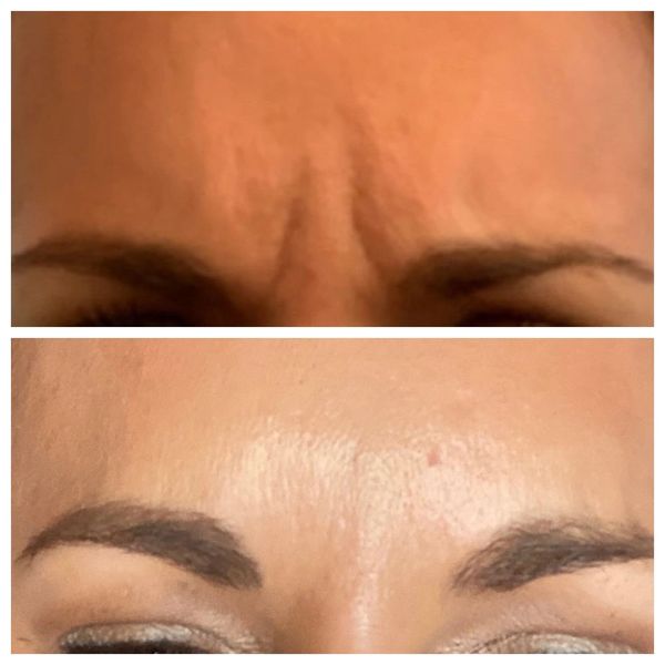 Wrinkle Relaxers Before and After 4