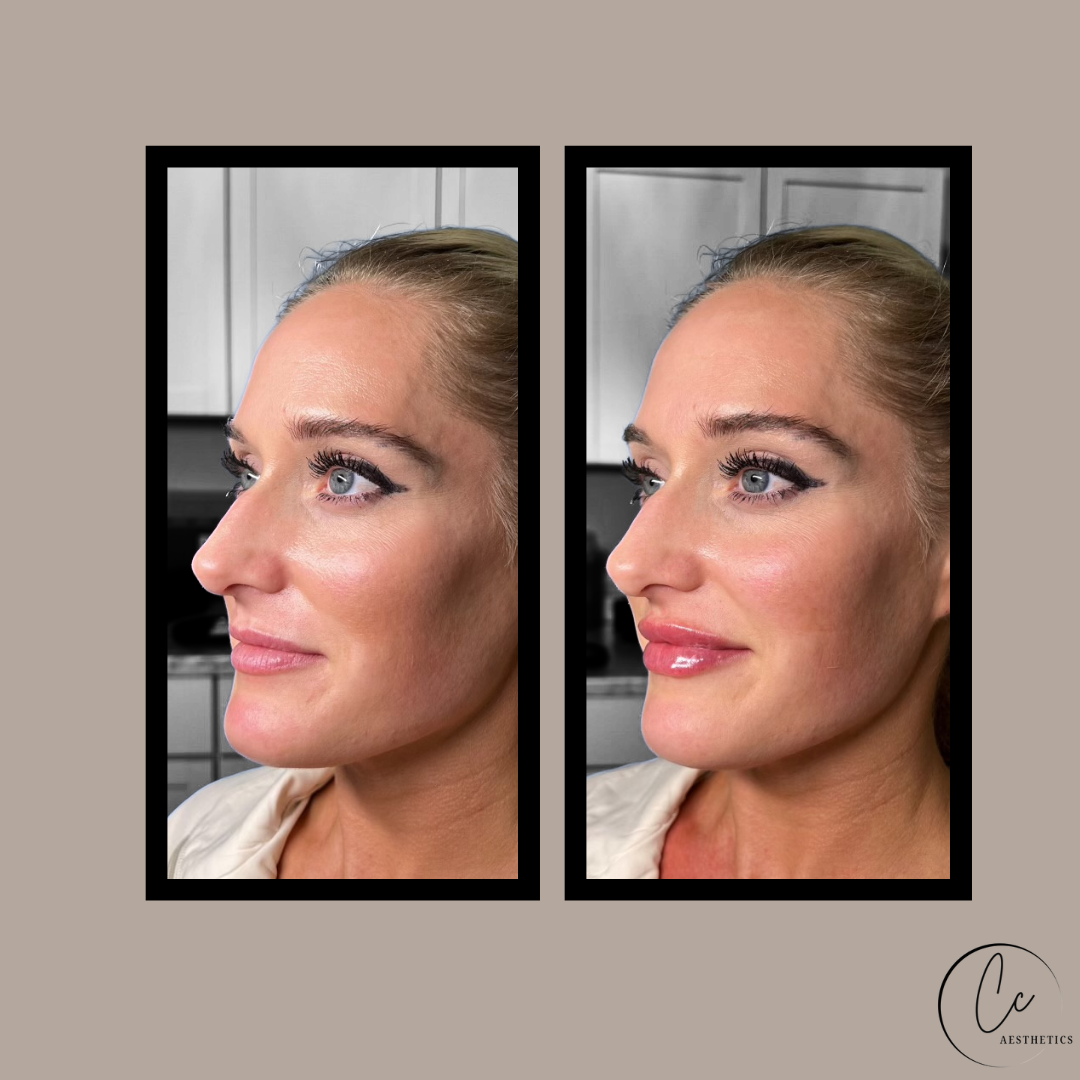 Lip Filler Results